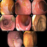 Endoscopic appearance of ACR