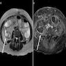 Acute cellular rejection (MRI)