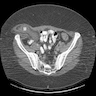 Intrathoracic myolipoma (CT)