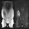 Intrathoracic myolipoma (MRI)