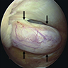 Arthroscopic view angiofibroma knee