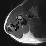 AVM right shoulder (MRI, axial T1)