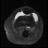 Popliteal AVM (MRI, axial PD fat sat)