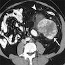 Large retroperitoneal mass with central necrosis