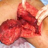 Intraoperative image of axillary tumor