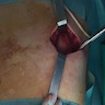 Intraoperative view of subscapular mass