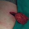 Surgical excision of the elastofibroma dorsi