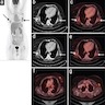 PET CT findings