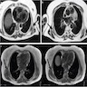 MRI with diffusion sequences