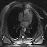 MRI of subscapular mass