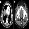 CT of subscapular and gluteal masses