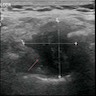 Ultrasonographic appearance