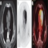 PET CT findings