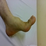 Foot tumor