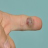 Raised nodular lesion on distal aspect of finger