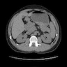 Retroperitoneal leiomyoma