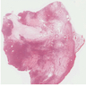 Leiomyoma with hydropic change
