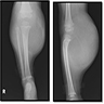 Localized mass of soft tissue, without calcification