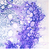 Mature adipocytes and lipoblasts