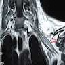 MRI showing enlarged brachial plexus