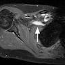 MRI showing enlarged brachial plexus