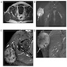 MRI: buttock mass