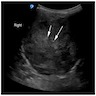 Ultrasound: buttock mass