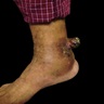 Exophytic tumor