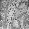 Ultrastructural features of neoplastic cells