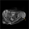 Well circumscribed tumor