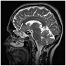 Ethmoid sinus mass
