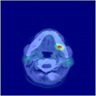 DOTATATE scan