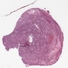 Dural based mass