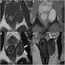 Ischiorectal fossa mass (MRI)