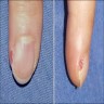 Subungual tumor distorting nail plate