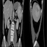 Heterogenous enhancing splenic lesion on CT