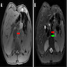T1 and T2 weighted MRI of splenic mass