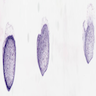 Follicular lymphoma touch preparation
