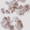 Hidradenoma papilliferum (GCDFP-15)