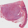 Gastric GIST