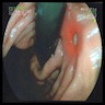 Ulcerated gastric mass