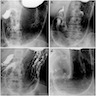 Atrophic gastritis barium Xray