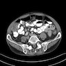 Gastric submucosal thickening