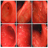 Endoscopic images of H. pylori infected gastric mucosa