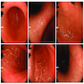 Endoscopic images of H. pylori infected gastric mucosa