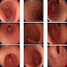 Chronic gastritis images with white light endoscopy