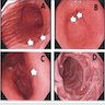 Findings of gastritis from upper endoscopy