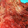 Gastritis erosiva