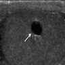 Cyst of testis (focal dilatation of seminiferous tubule)