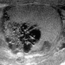 Cystic dilatation (tubular ectasia) of rete testis